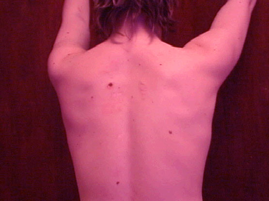 Full View of My Scared Back